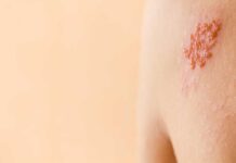 Herpes zóster: la amenaza silenciosa en adultos mayores y los nuevos avances en prevención vacunal